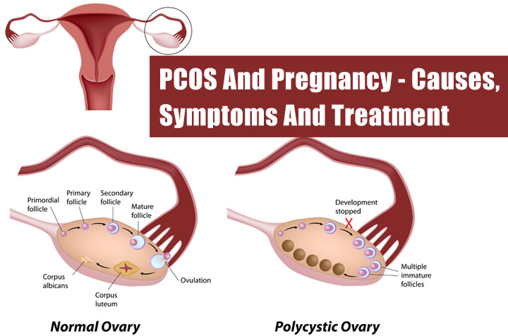 uploads/blogs/pcos.jpeg